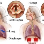 Hiccups - Symptoms and causes
